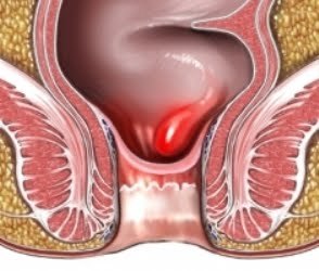 obat alami wasir eksternal