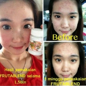 TUTORIAL CARA MENGHILANGKAN JERAWAT Ponorogo<br/>