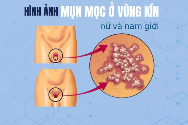 HÌNH ẢNH MỤN RỘP MỌC Ở VÙNG KÍN NAM & NỮ