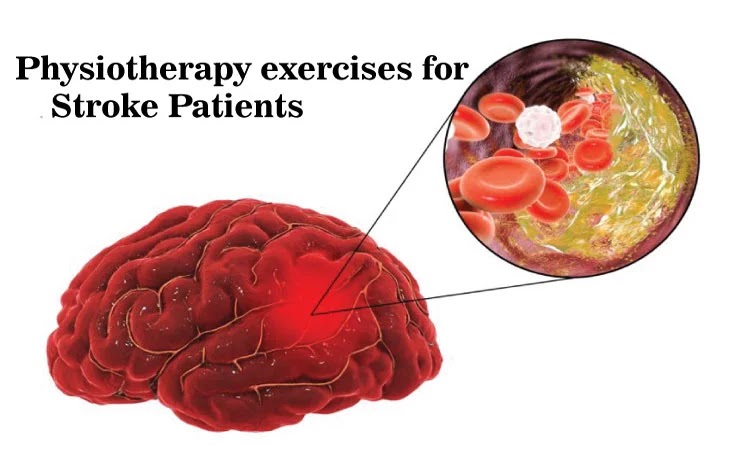 The Top 8 Physiotherapy Exercises for Stroke Patients