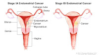 What Causes Fluid In The Uterus After Menopause