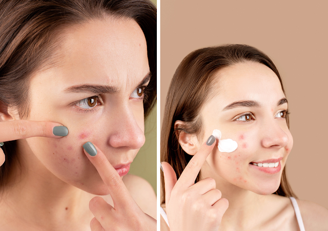 What Is Acne And How to Treat It