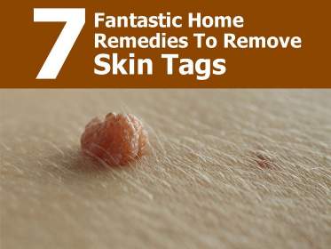 skin tags fix