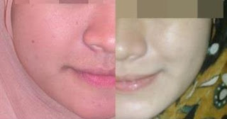 Foot Patch Detox Original (Korea): SUPER GLUTHA PENCERAH 