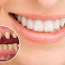 Có nên bọc răng sứ không với răng bị hô nhẹ?