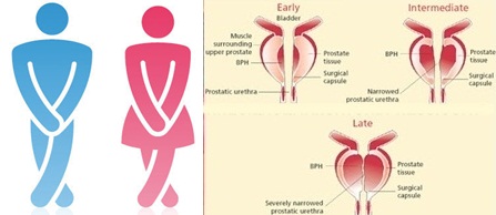 Cara Mengatasi Susah Buang Air Kecil Secara Efektif Dan Cepat (Obat Susah Kencing)