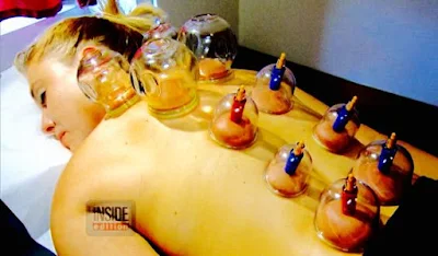 cupping in NYC