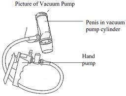 Erectile Dysfunction Pumps