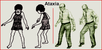 Pengertian Penyakit Pada Otak Ataksia (Ataxia)