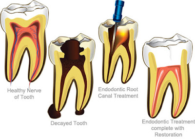  Quy trình lấy tủy khi bọc răng sứ 