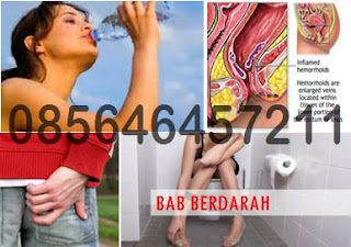 Obat Susah BAB Ada Benjolan Wasir Dalam Anus