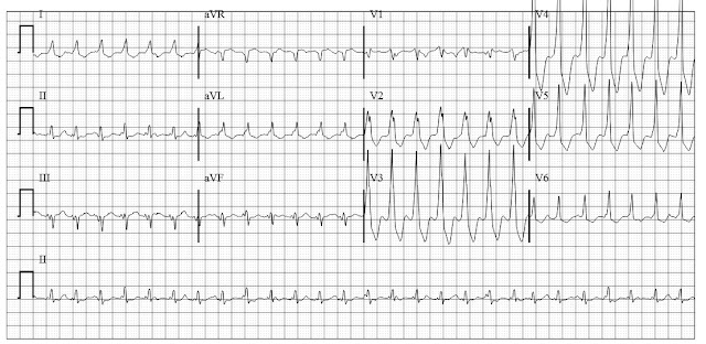 ECG of VT