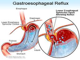gastrik, gastroesophageal reflux