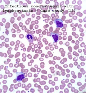 Case study (15)- Infectious mononucleosis with lymphocytosis