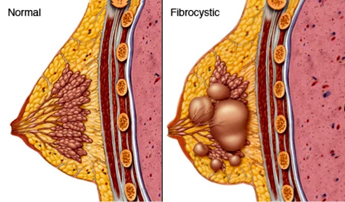 Fibrocystic Breast / ஃபைப்ரோசிஸ்டிக் மார்பகம்