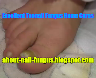 Excellent Toenail Fungus Home Cures