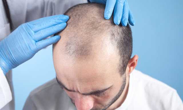 Doctors warn of illegal hair transplants in north Cyprus