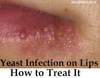 Yeast Infection on Lips - How to Treat It