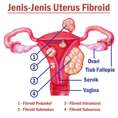 apa itu fibroid