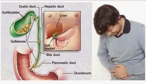 Penyakit Batu Empedu