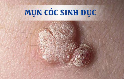 Mụn cóc sinh dục là bệnh gì và chữa ở đâu?