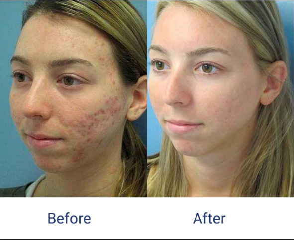 Laser Acne Scar Removal Side Effects Of Laser Treatment For Acne