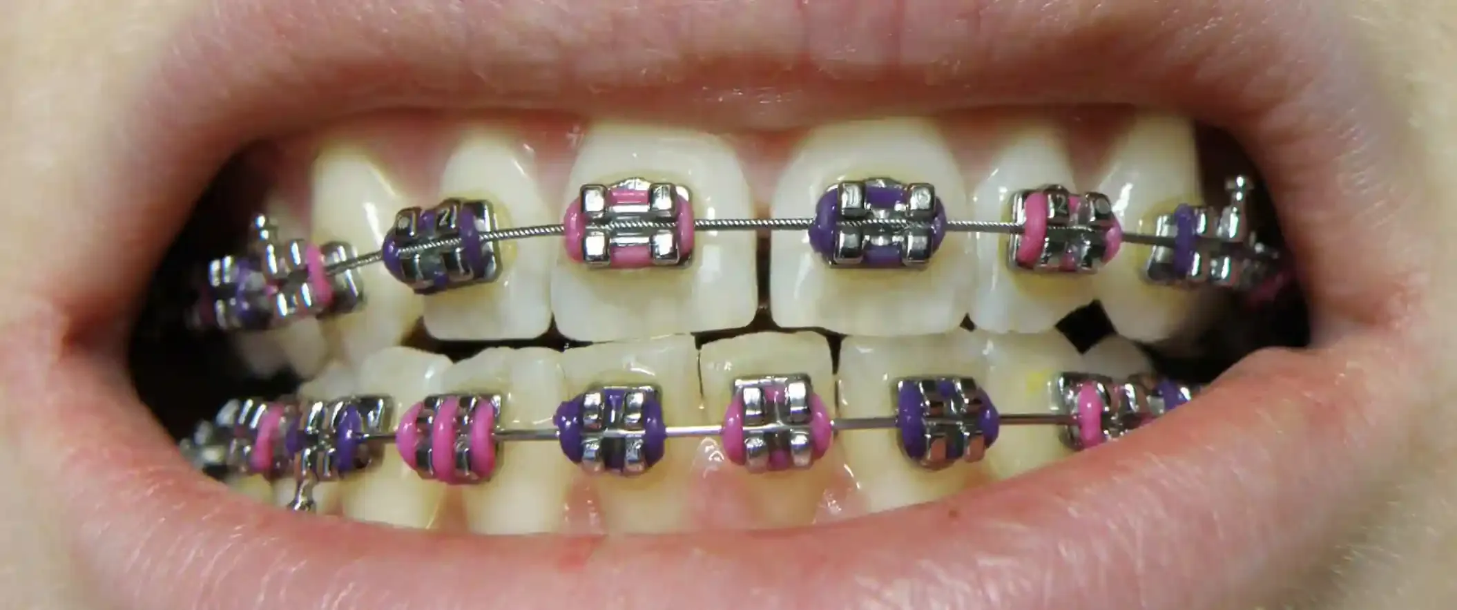 What are the best colors for braces?
