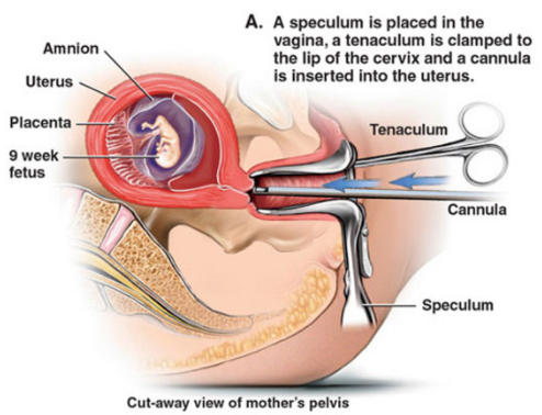 Metode Aborsi di Klinik