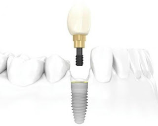 Trồng răng implant giá bao nhiêu tiền ?