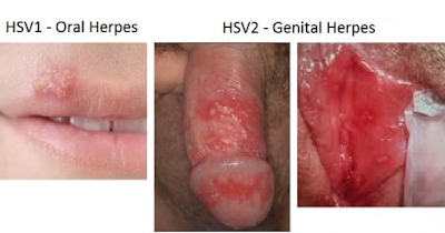 cara menyembuhkan herpes genital