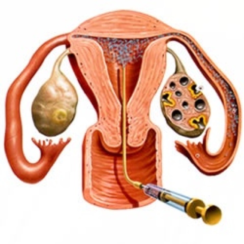 IUI-procedure-finally-egg-meet-sperm-Edmonton