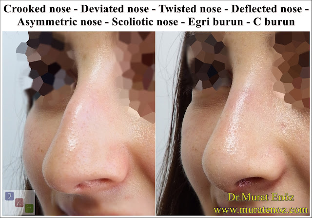 Female Nose Aesthetic Surgery - Nose Jobs For Women - Nose Reshaping for Women - Best Rhinoplasty For Women Istanbul - Female Rhinoplasty Istanbul - Nose Job Surgery for Women - Women's Rhinoplasty - Nose Aesthetic Surgery For Women - Female Rhinoplasty Surgery in Istanbul - Female Rhinoplasty Surgery in Turkey - Crooked nose - Deviated nose - Twisted nose - Deflected nose - Asymmetric nose - Scoliotic nose - Eğri burun - C burun - S-shaped crooked nose deformity -  Rhinoplasty Istanbul - Rhinoplasty in Istanbul - Rhinoplasty Turkey - Rhinoplasty in Turkey – Rhinoplasty doctor in Istanbul – ENT doctor in Istanbul - Nose Job in Istanbul - Before and after rhinoplasty photo