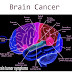 Brain Cancer Symptoms, Types, and Prognosis Complete