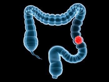 Fluid Volume Deficit and Imbalanced Nutrition - NCP for Bowel Obstruction
