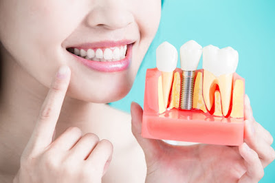 dental implant in Ahmedabad