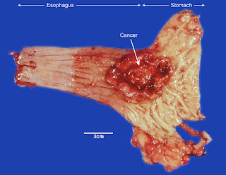 Types Of Most Common Cancer,Early Skin Cancer,Primary Liver Cancer,Most Common Cancer Types