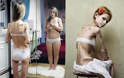 Anorexia y bulimia