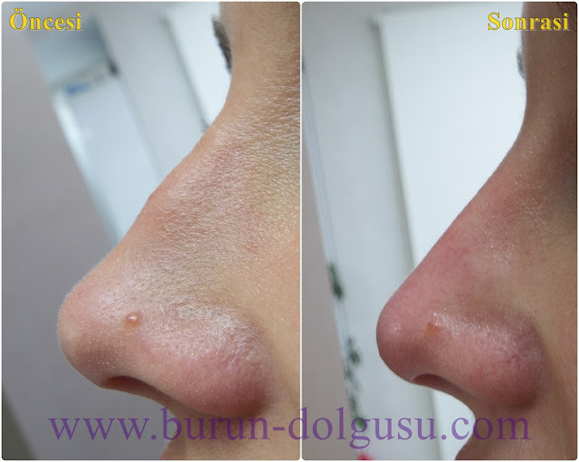 Non-surgical nose job - Non surgical nose job with filler in İstanbul - Non-surgical rhinoplasty in İstanbul - Nose tip filler augmentation in İstanbul - Non-surgical rhinoplasty in İstanbul - Nose filler injection in Turkey - The 5 Minute Nose Job in İstanbul, Turkey - Non-surgical nose job in Istanbul - Non-surgical nose job istanbul - Nose filler injection Turkey - Injectable nose job - Liquid rhinoplasty