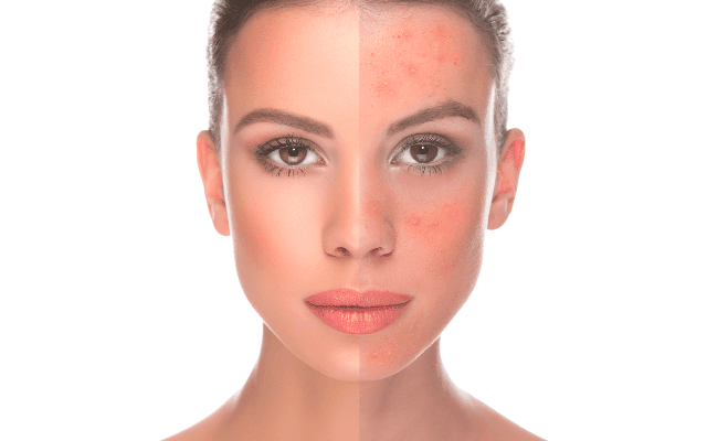 face redness treatment