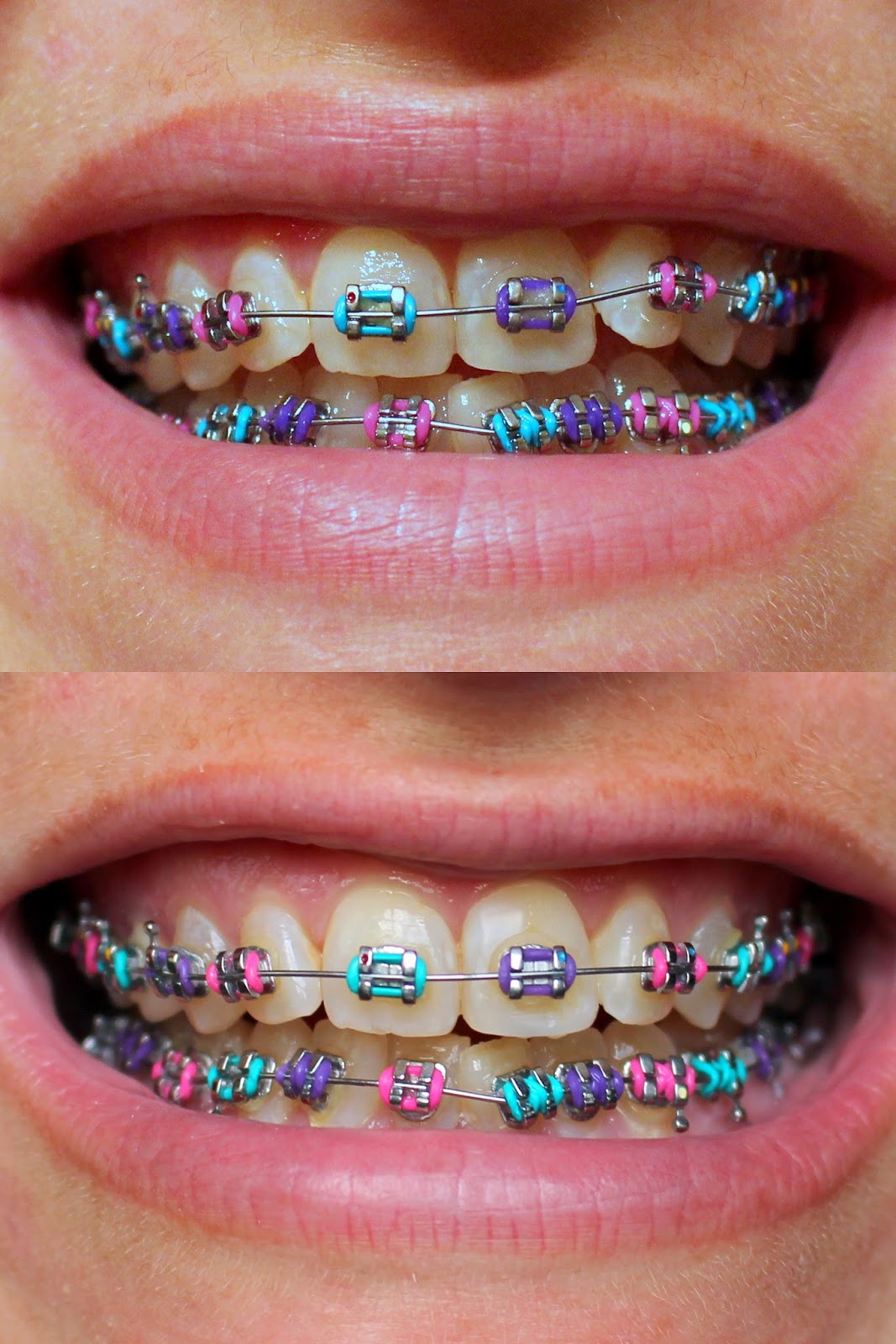 Braces Braces Rubber Bands And Braces Colors On Pinterest Coloring Wallpapers Download Free Images Wallpaper [coloring654.blogspot.com]