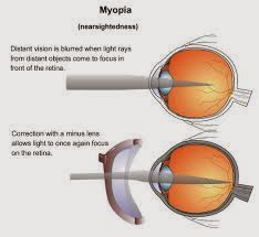 Cara Terapi Mengobati Mata Rabun Jauh ( Minus )