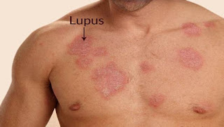 Penyakit Lupus: Jenis, Gejala Dan Penyebabnya