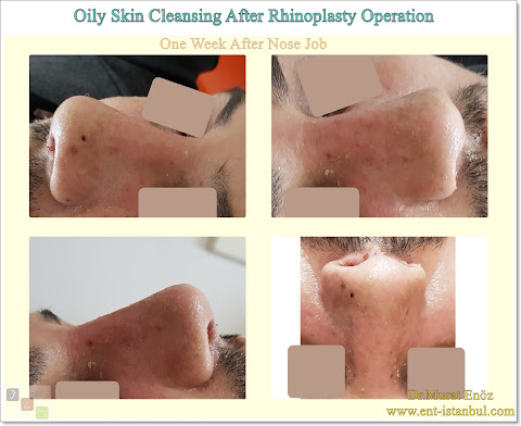 Oily Skin Cleansing After Rhinoplasty Operation