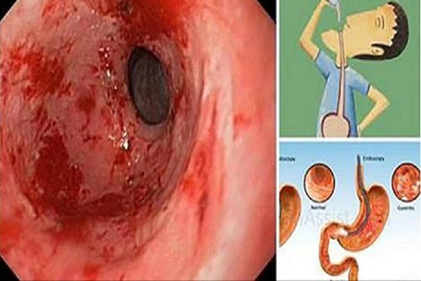 Eliminate Gastritis And Heartburn In The Blink Of An Eye With This Powerful Natural Remedy