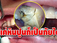 อุทาหรณ์เตือนใจคนแปรงฟันไม่สะอาด!! แค่คราบ “หินปูน” ในช่องปาก ก็เป็นภัยได้
