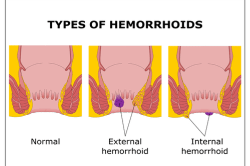What are hemorrhoids and what are its types? | healthy care
