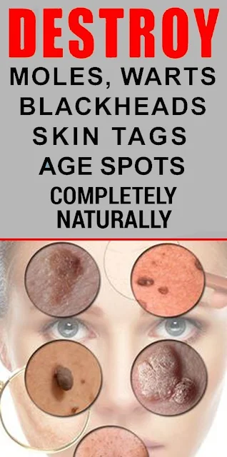 How to Remove Skin Tags, Moles, Blackheads, Spots & Warts by Using Natural Remedies Easily