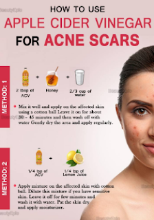 Apple Cider Vinegar For Acne - The Best Kept Skin Care Secret