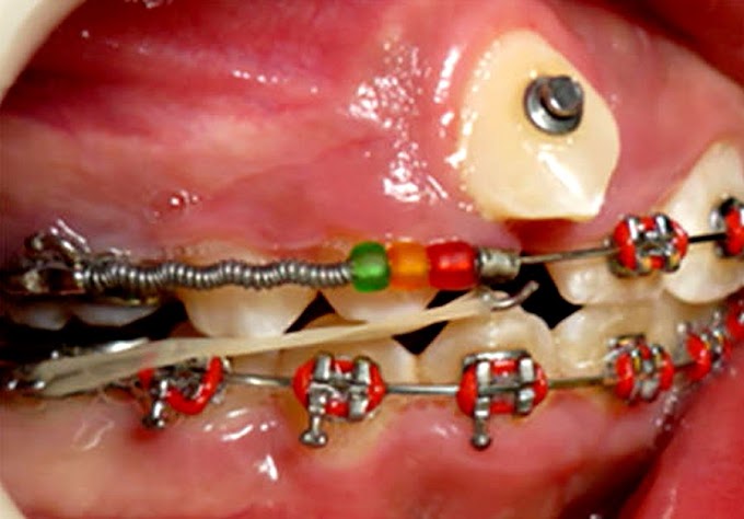 Tratamiento de ortodoncia sin extracción dental - Revisión de la literatura