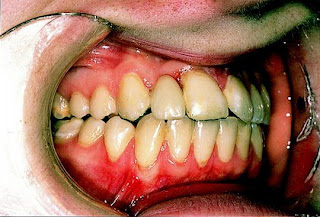 Gingivitis, Peradangan Pada Gusi